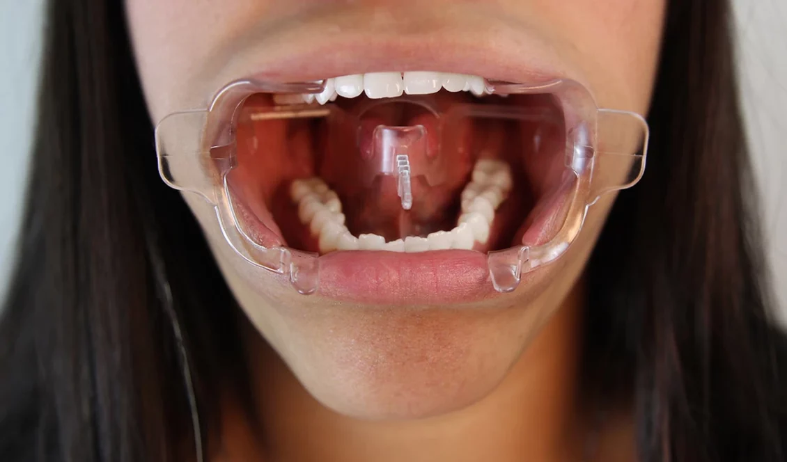 Clearfield Adult sized, Orthodontic Cheek retractor demonstration image