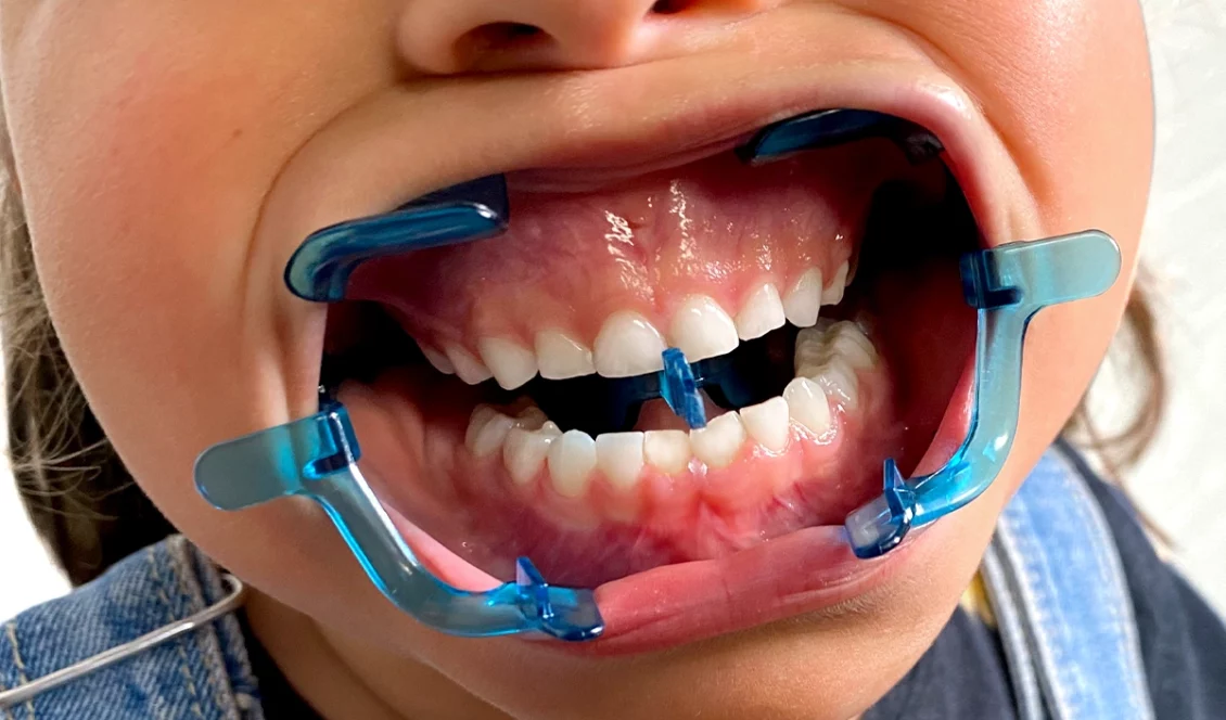 Clearfield Pediatric sized, Orthodontic Cheek retractor demonstration image
