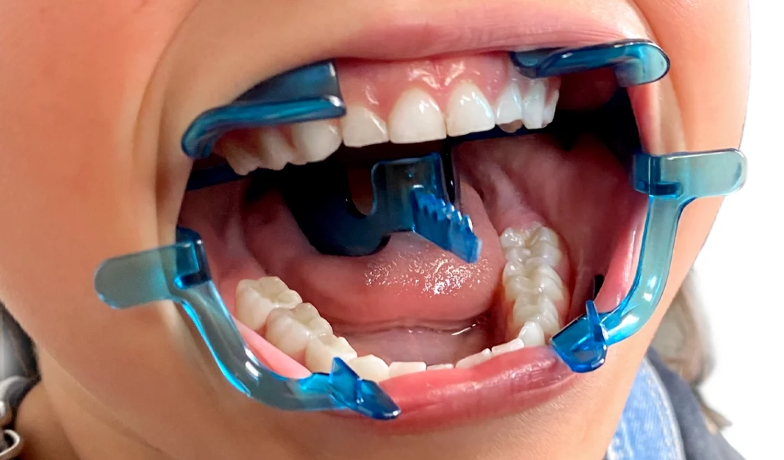 Clearfield Pediatric sized, Orthodontic Cheek retractor demonstration image